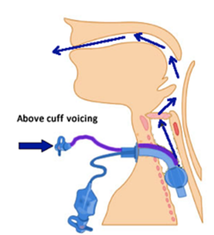Diagram of above cuff vocalisation - air flowing through a sub-glottic port into the trachea, through the vocal cords and out through the mouth 